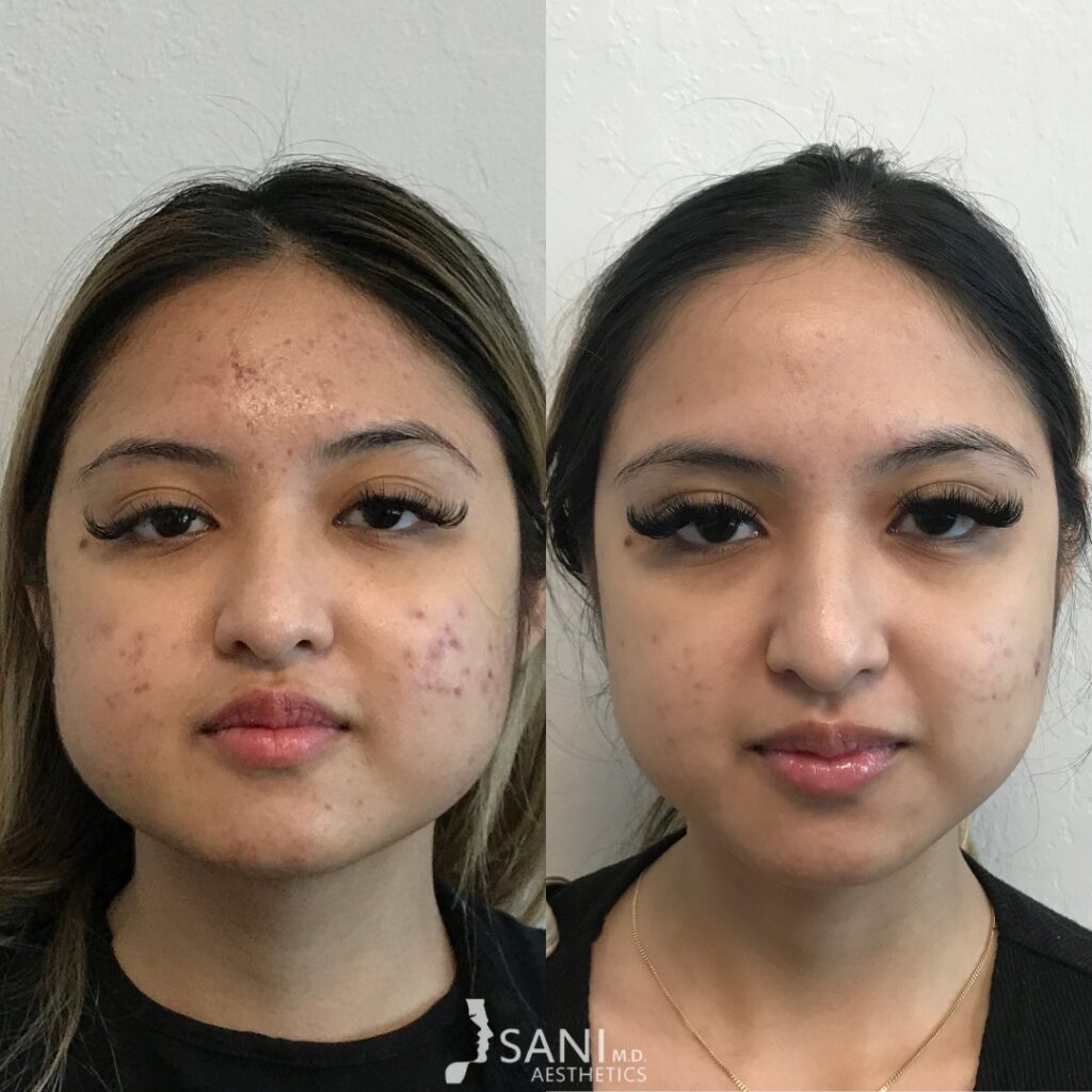 Botox- before and after
