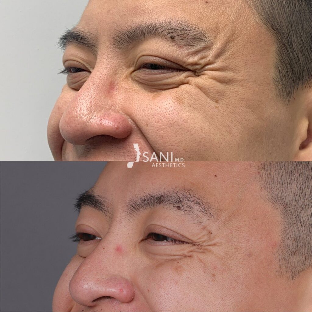 Botox- before and after
