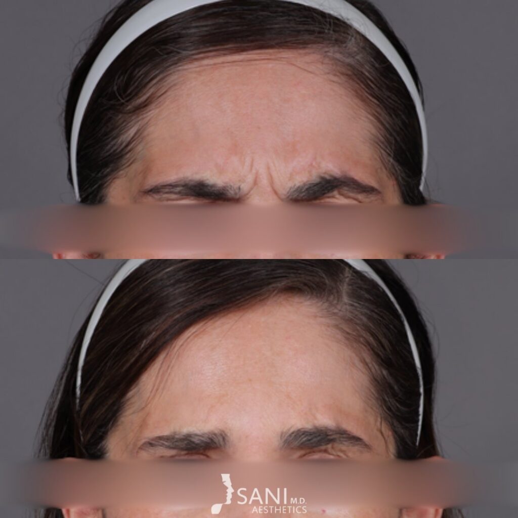 Botox- before and after