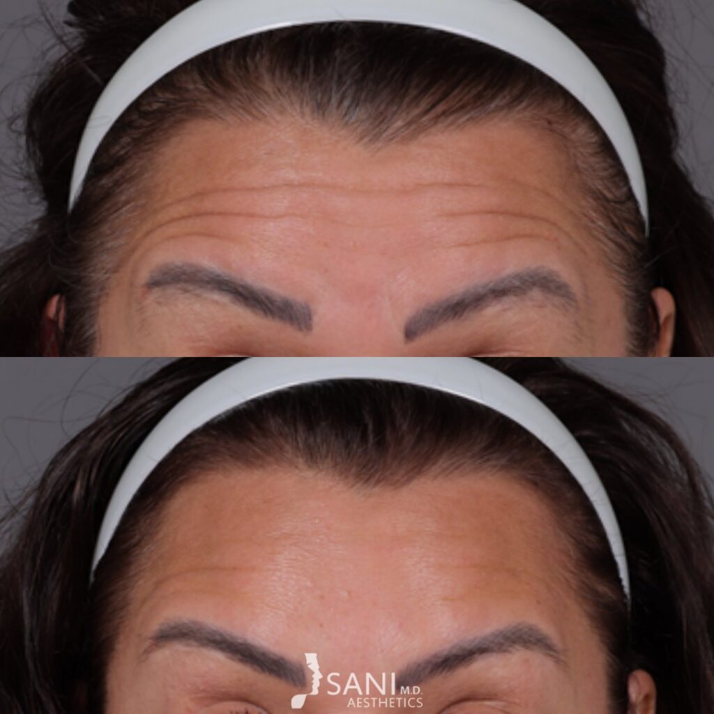 Botox- before and after