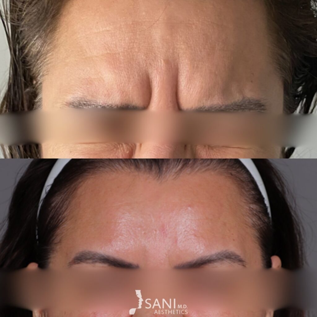 Botox- before and after