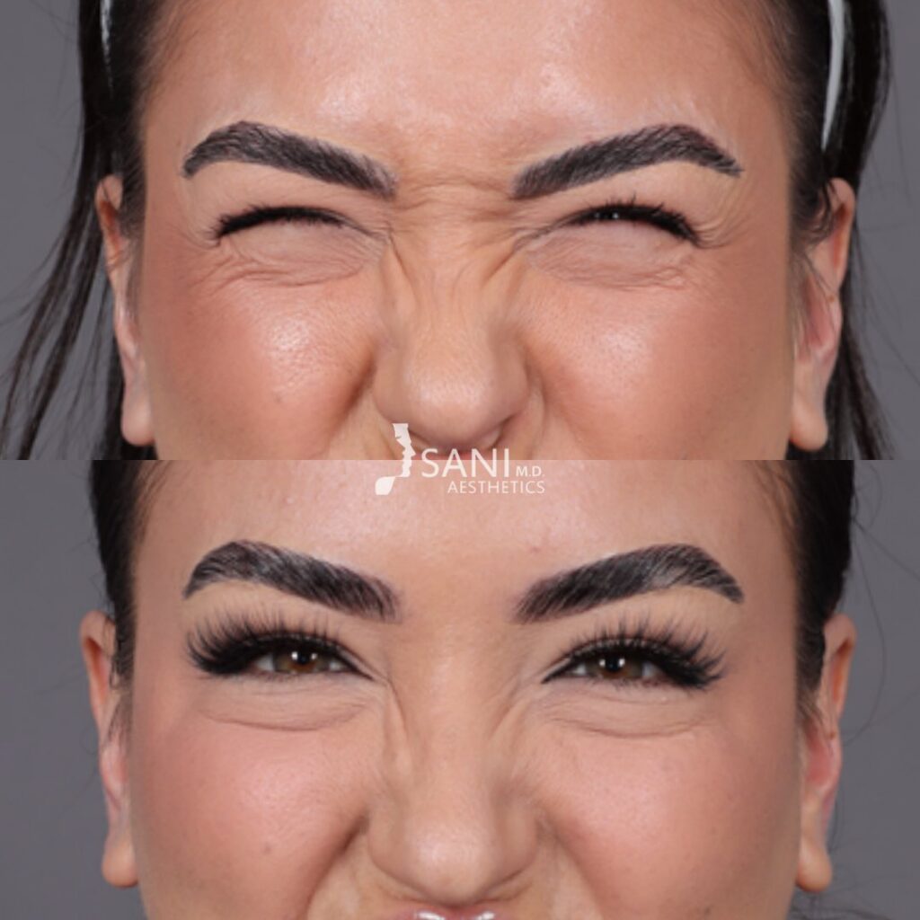 Botox- before and after
