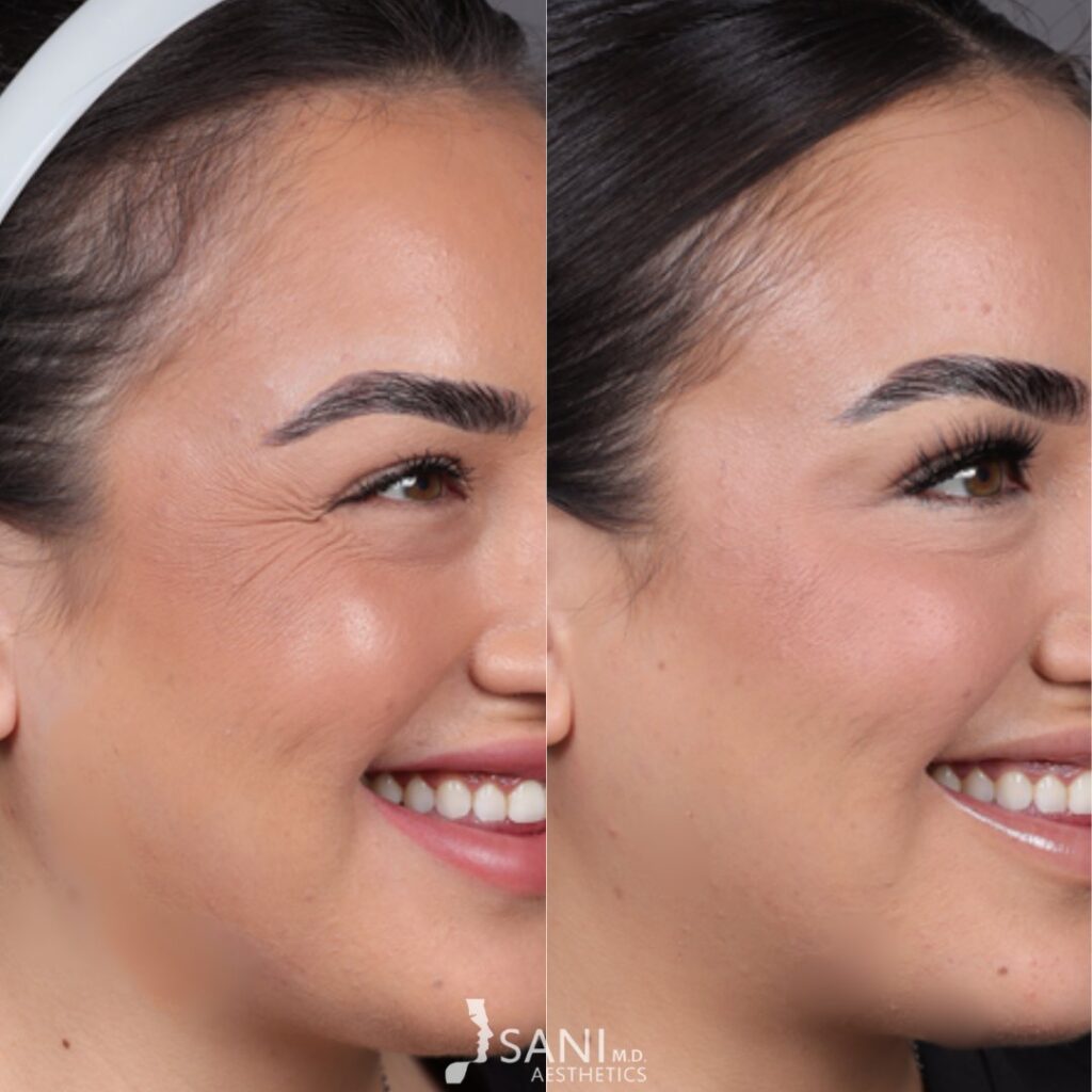Botox- before and after