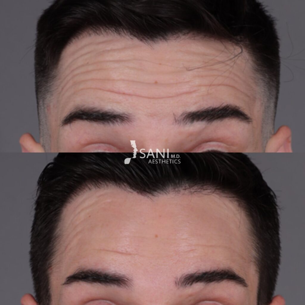 Botox- before and after