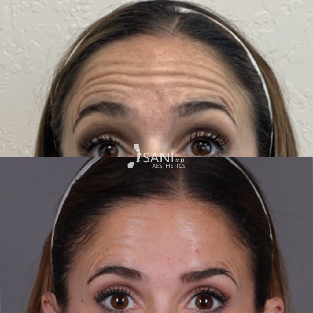 Botox- before and after