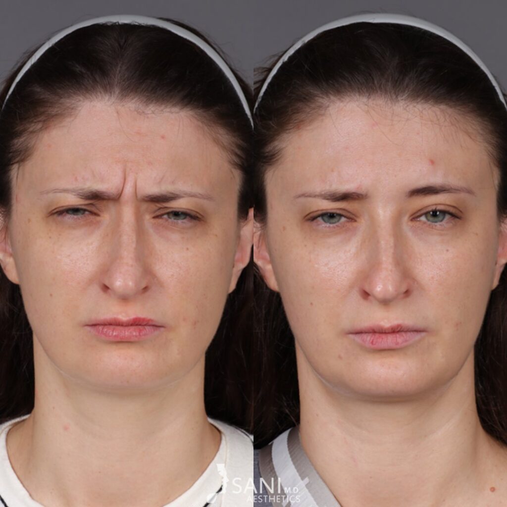 Botox- before and after