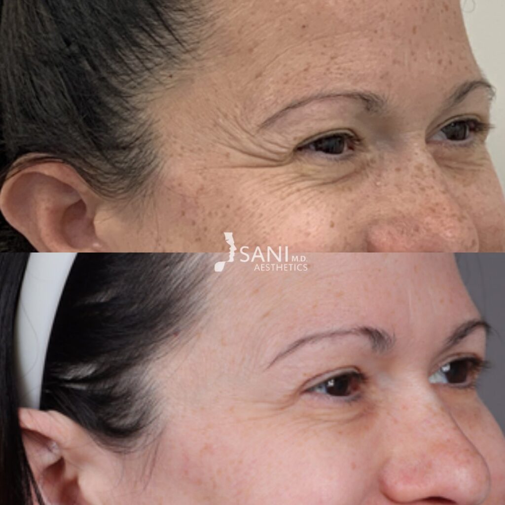 Botox- before and after
