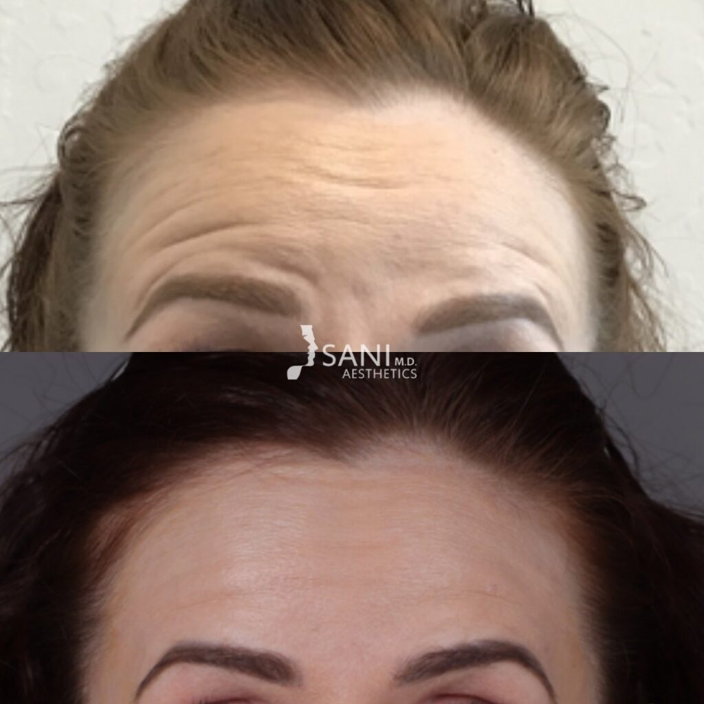 Botox- before and after