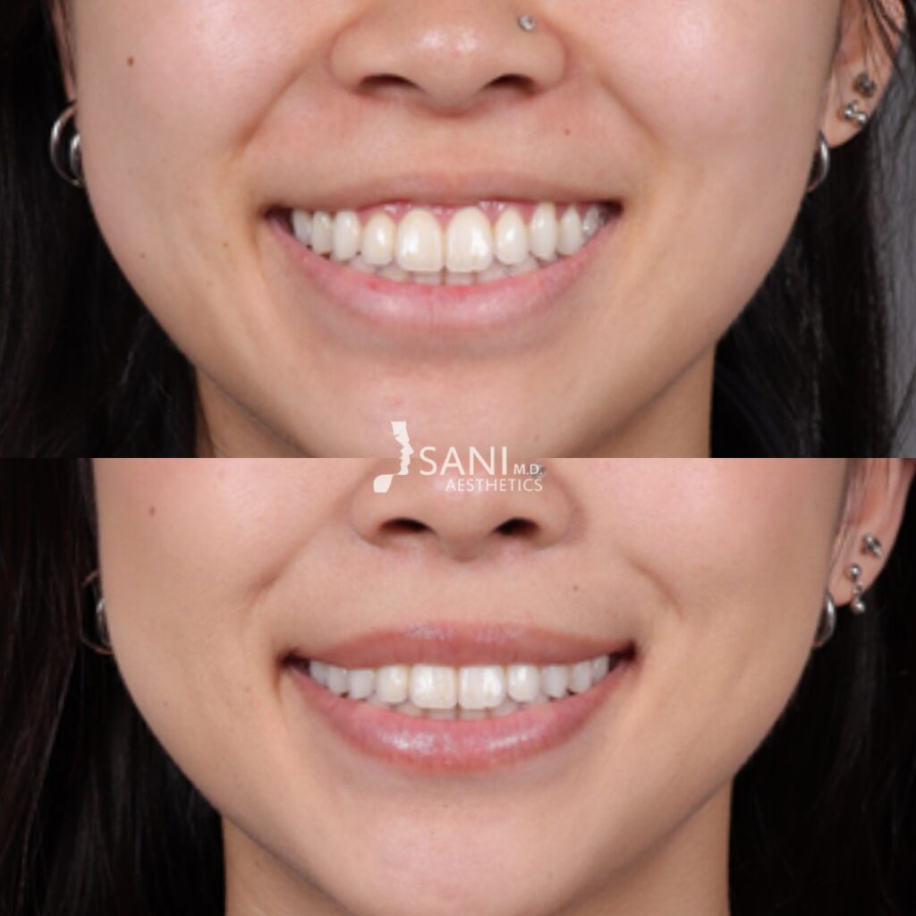 Botox- before and after
