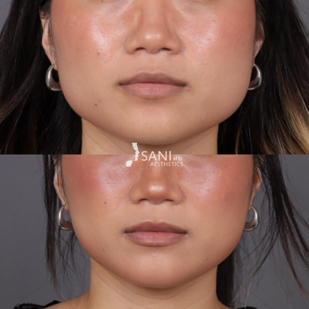 Botox- before and after