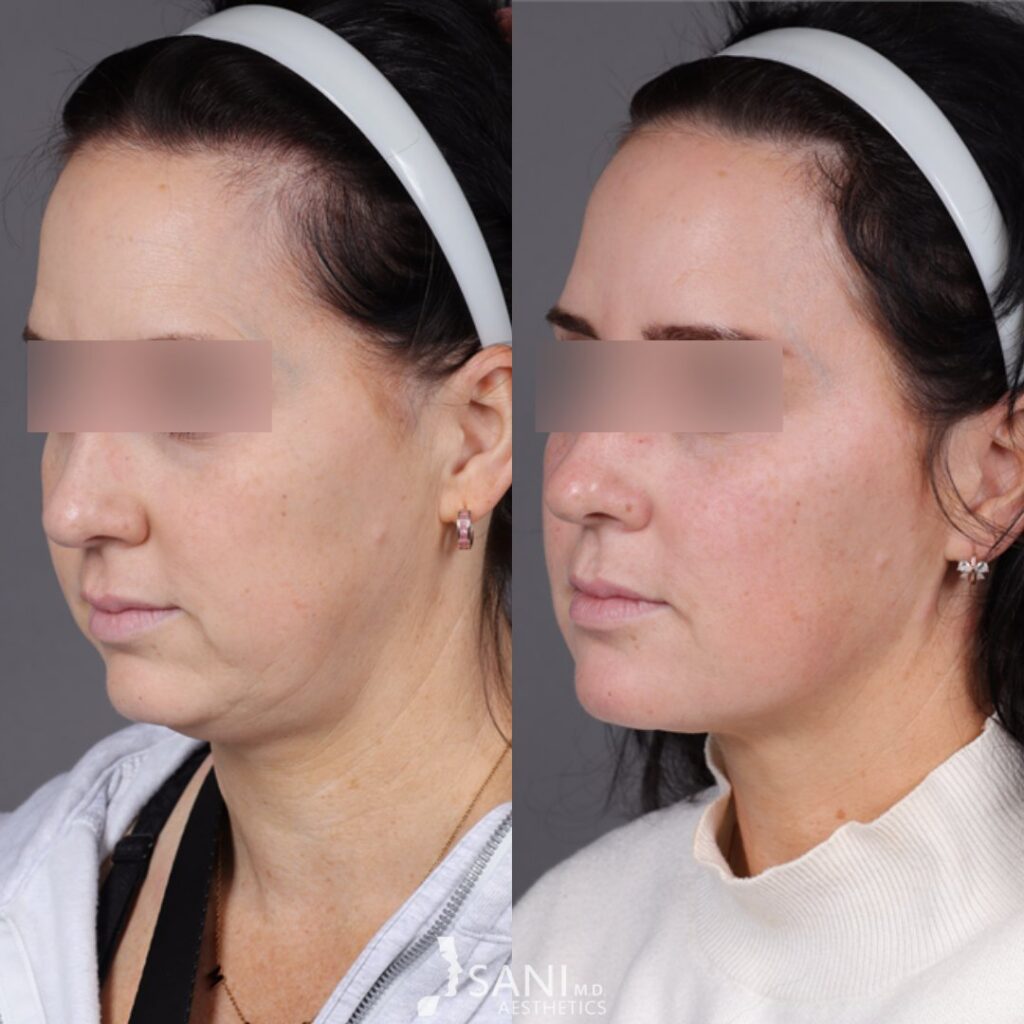 Dermal Filler- before and after