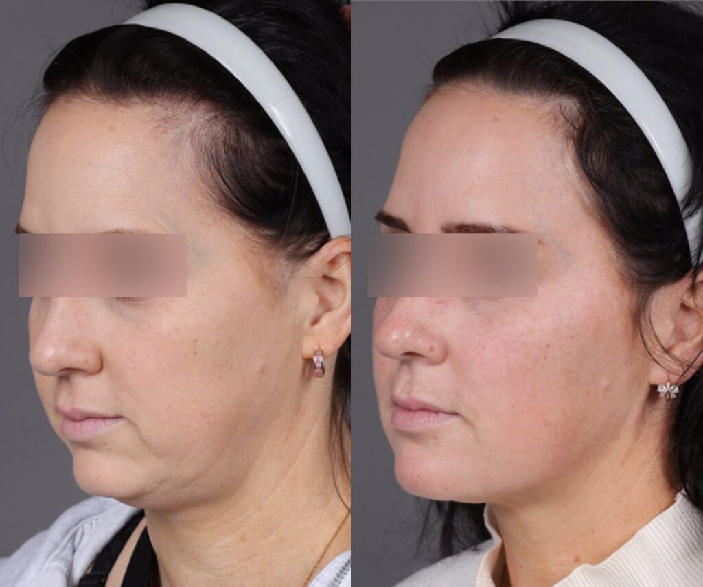 Dermal Filler- before and after