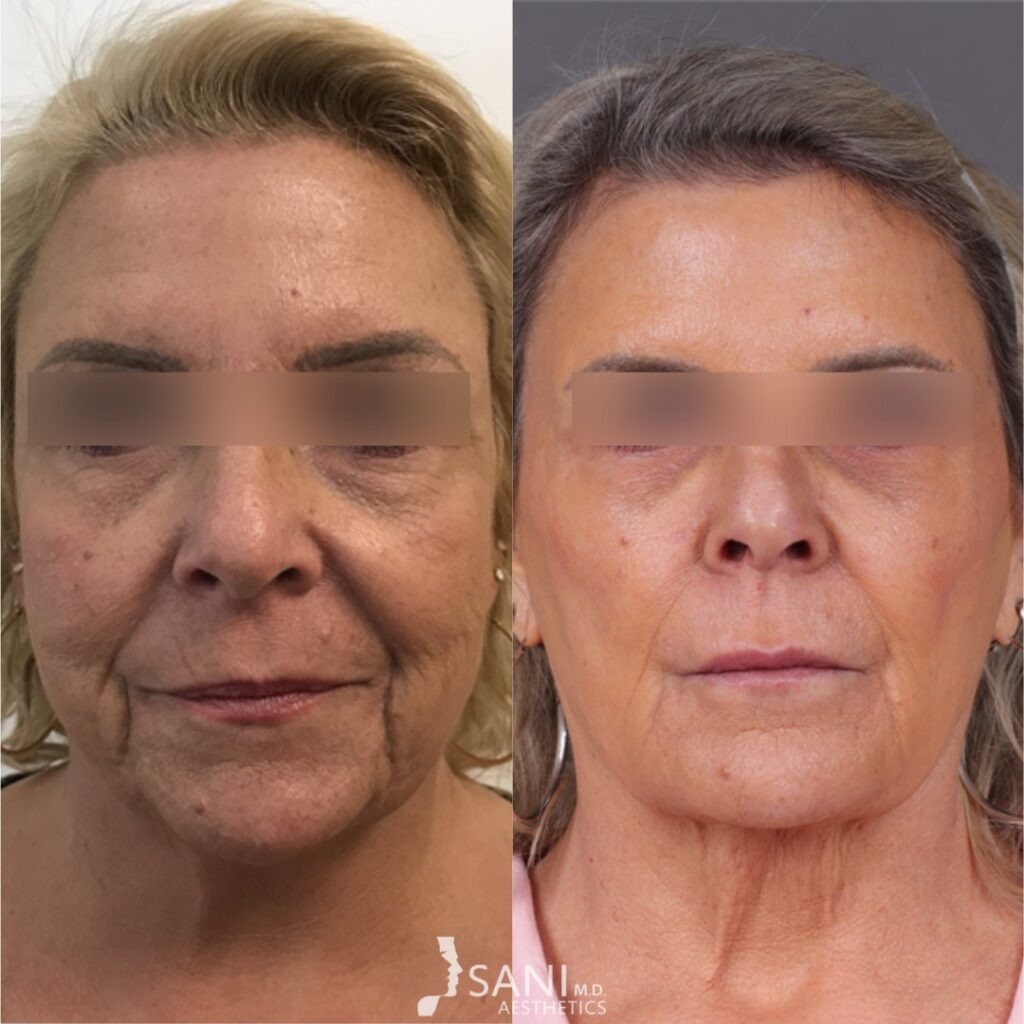 Dermal Filler- before and after