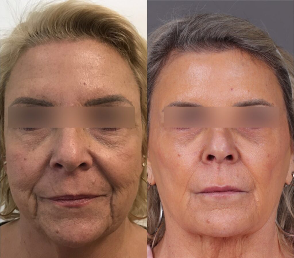 Dermal Filler- before and after