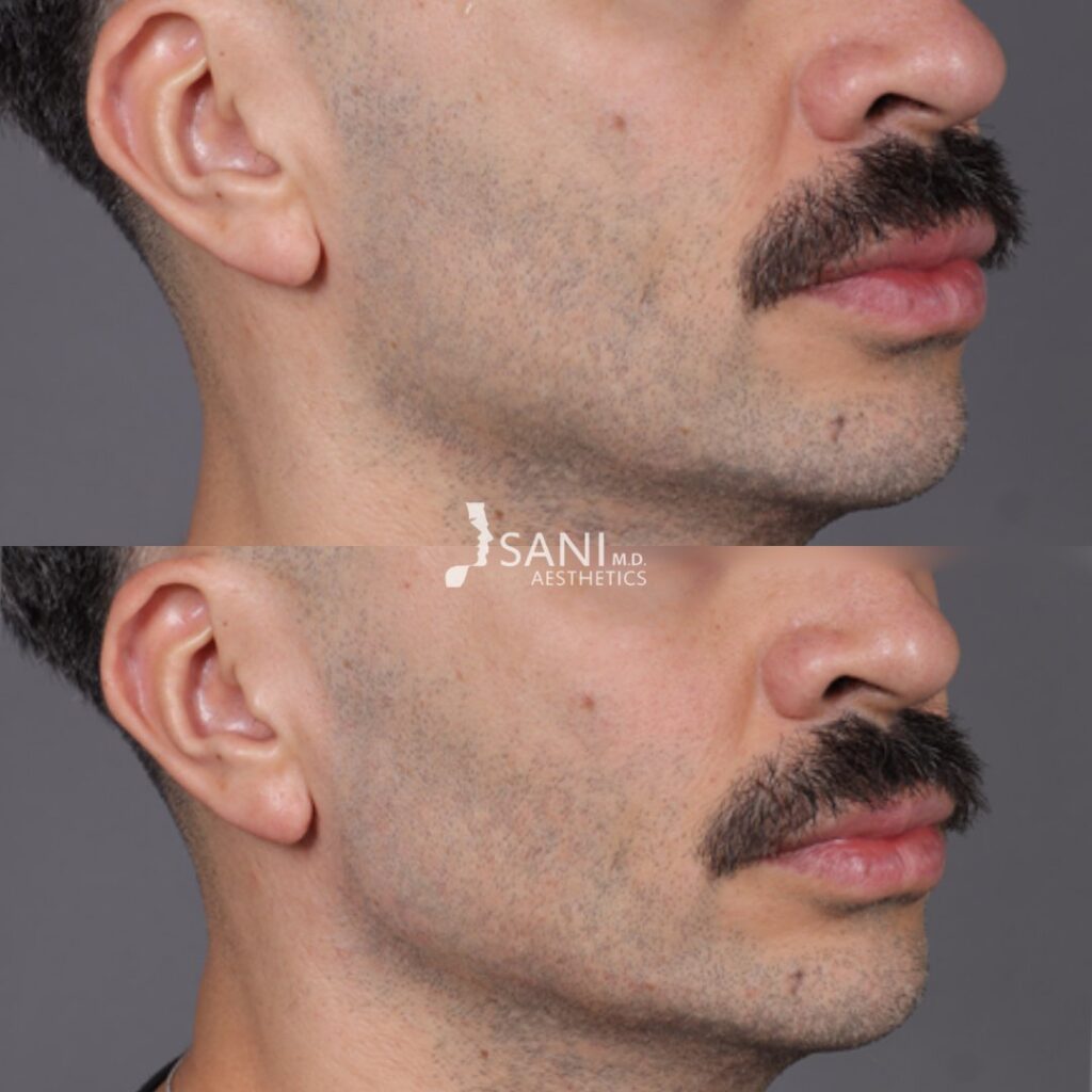 Dermal Filler- before and after