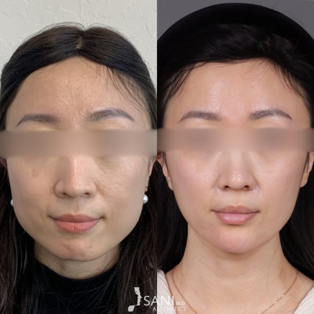 Dermal Filler- before and after