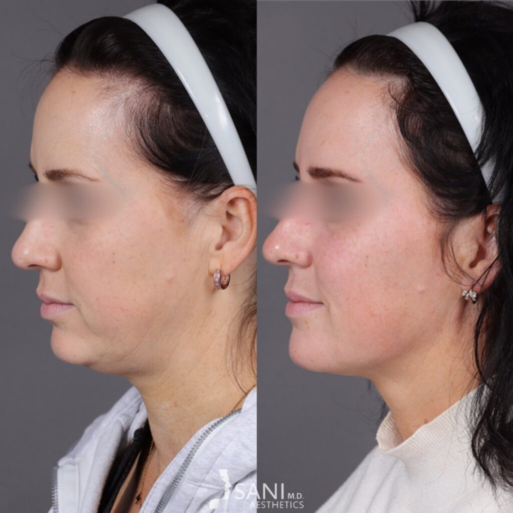 Dermal Filler- before and after