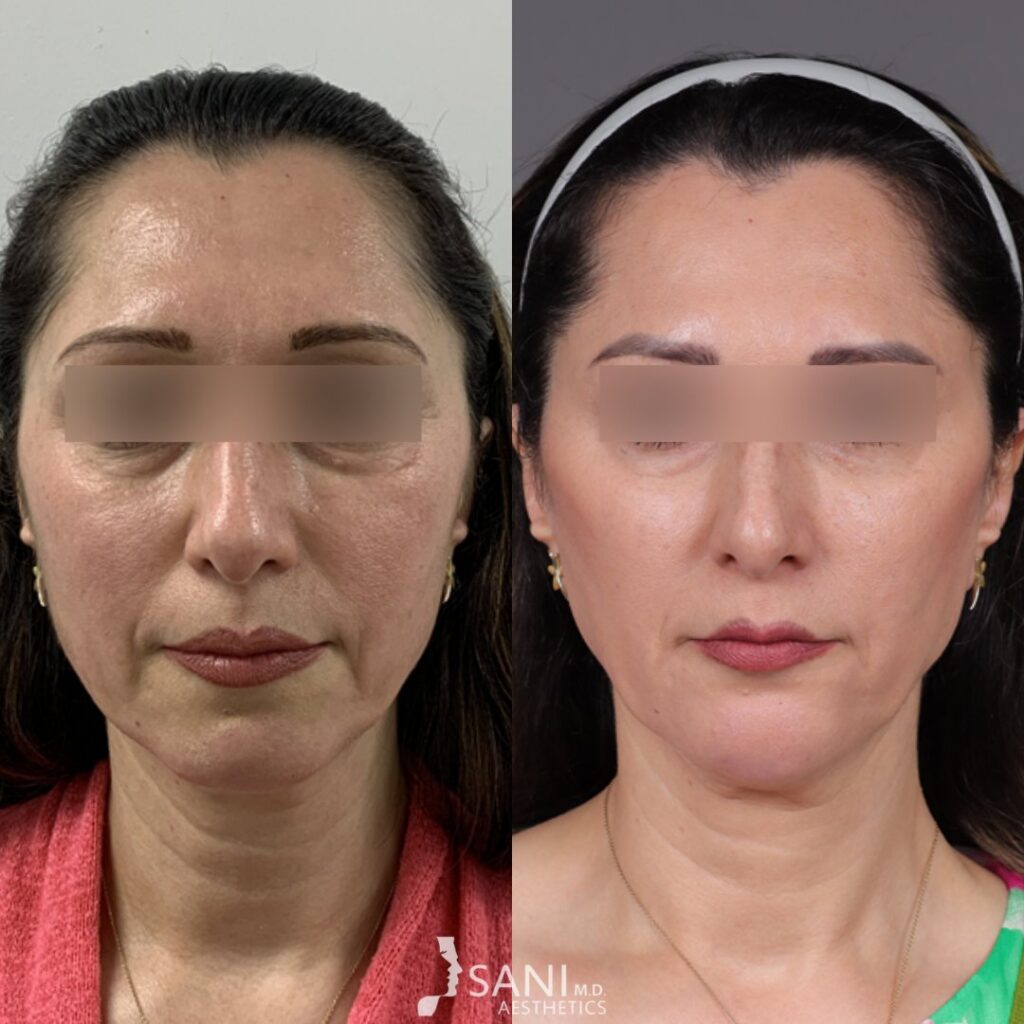Dermal Filler- before and after