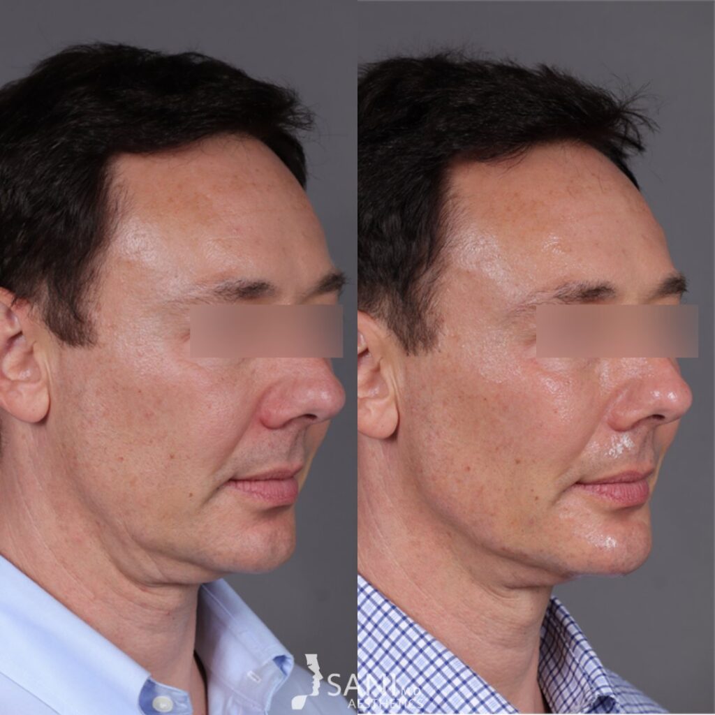 Dermal Filler- before and after