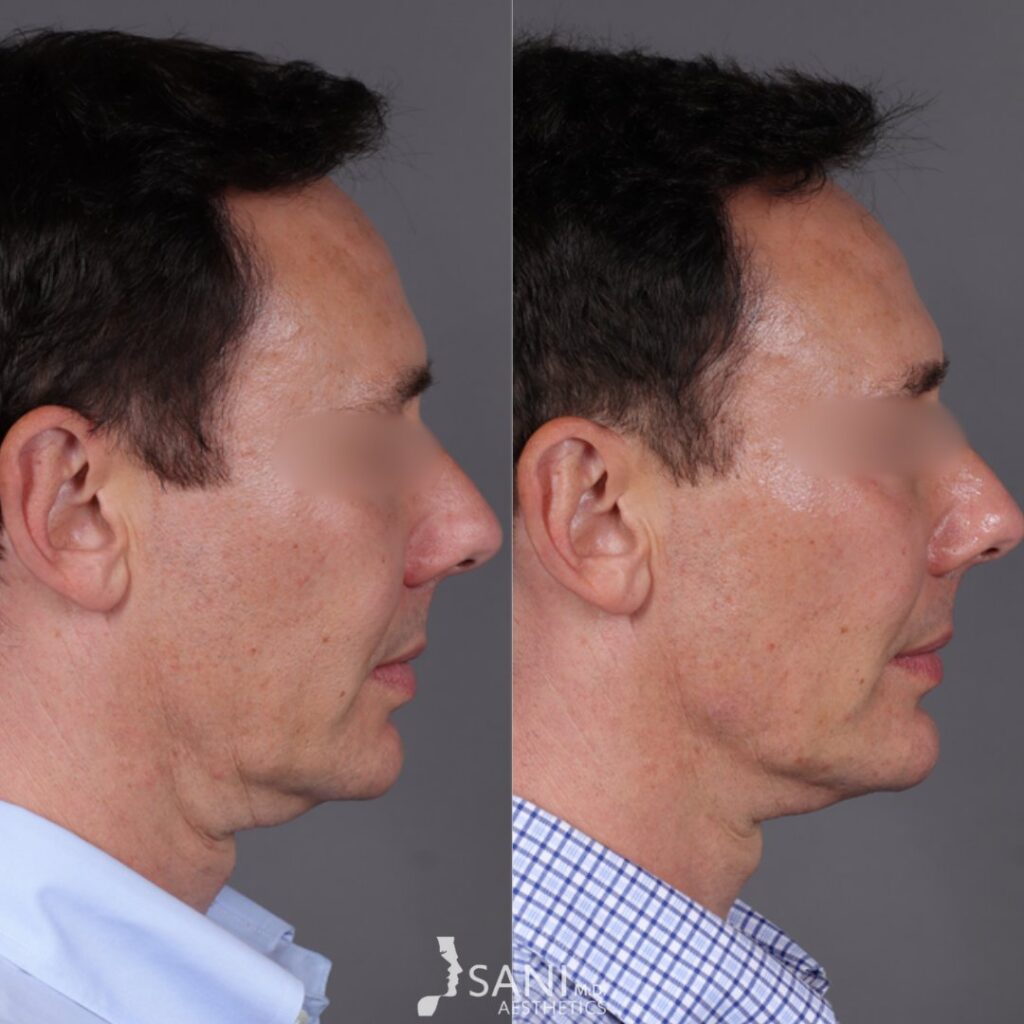 Dermal Filler- before and after