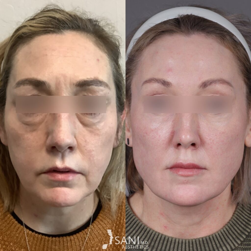 Dermal Filler- before and after