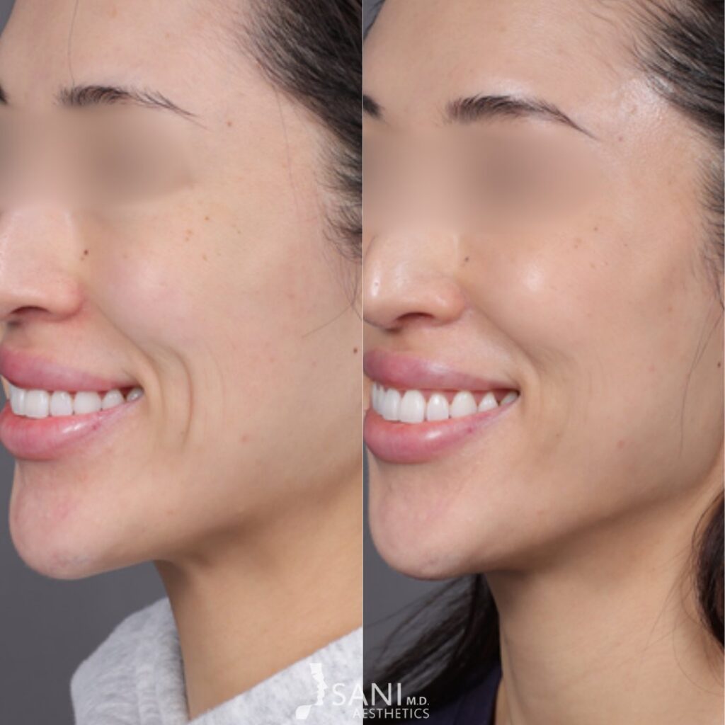 Dermal Filler- before and after
