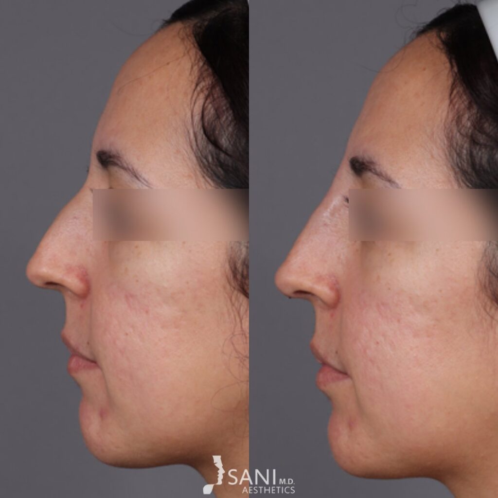 Dermal Filler- before and after