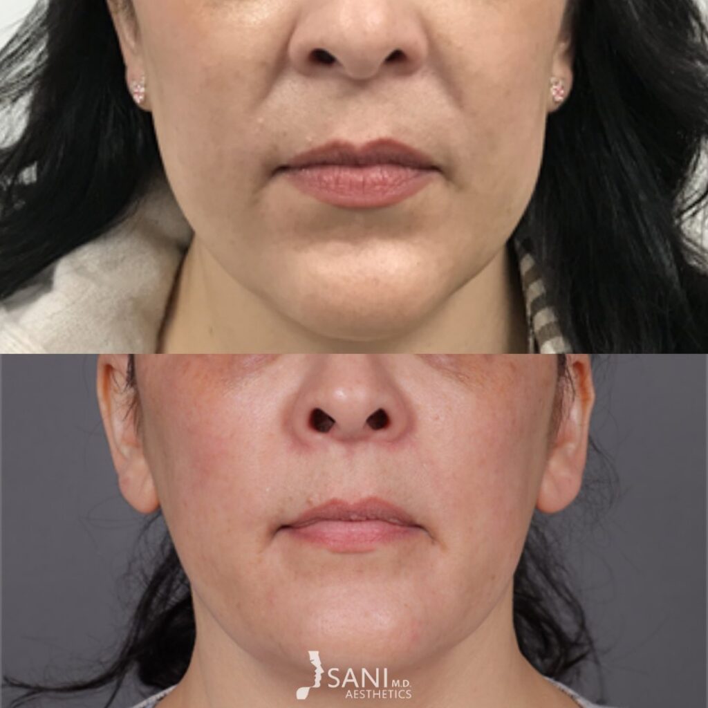 Dermal Filler- before and after