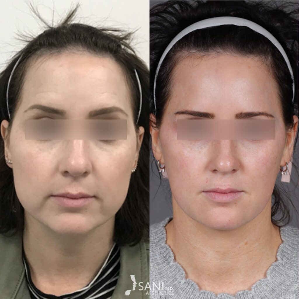 Dermal Filler- before and after