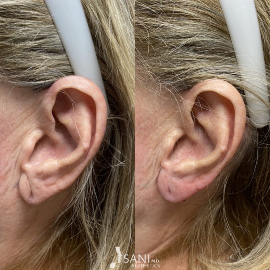 Dermal Filler- before and after