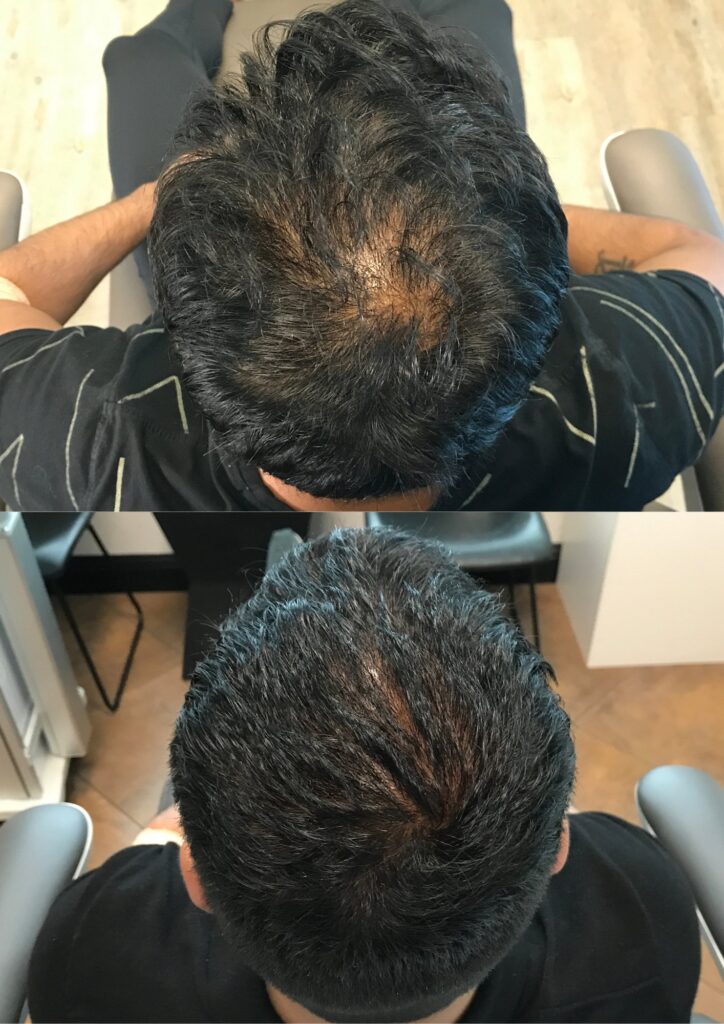 PRP for hair- before and after