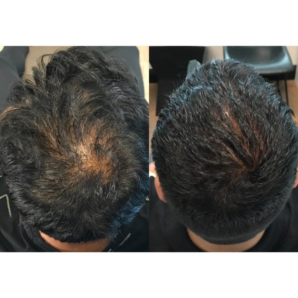 PRP for hair- before and after