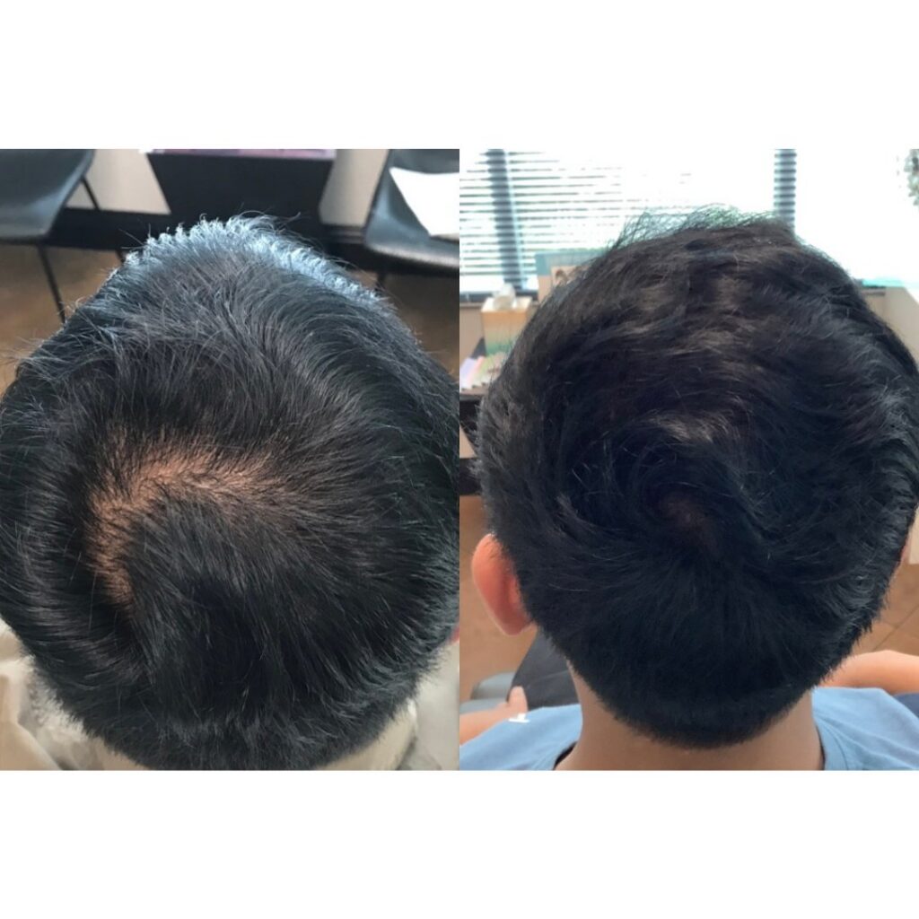 PRP for hair- before and after