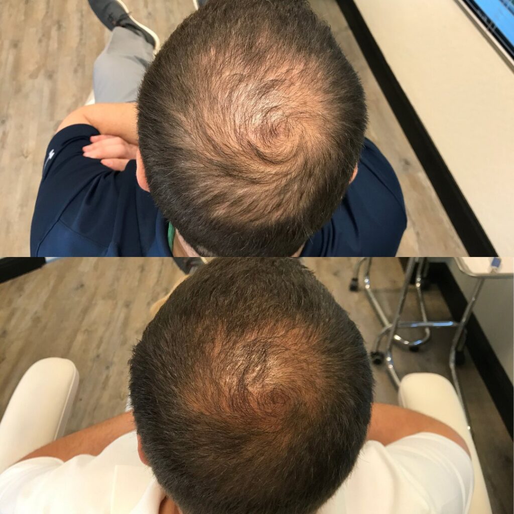 PRP for hair- before and after