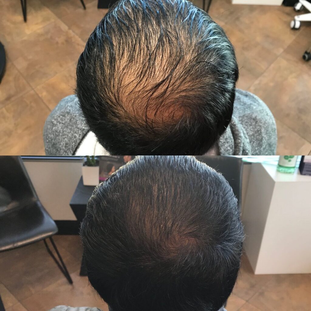 PRP for hair- before and after