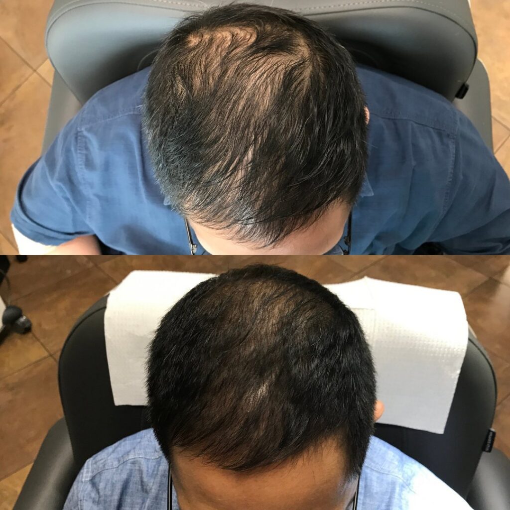PRP for hair- before and after