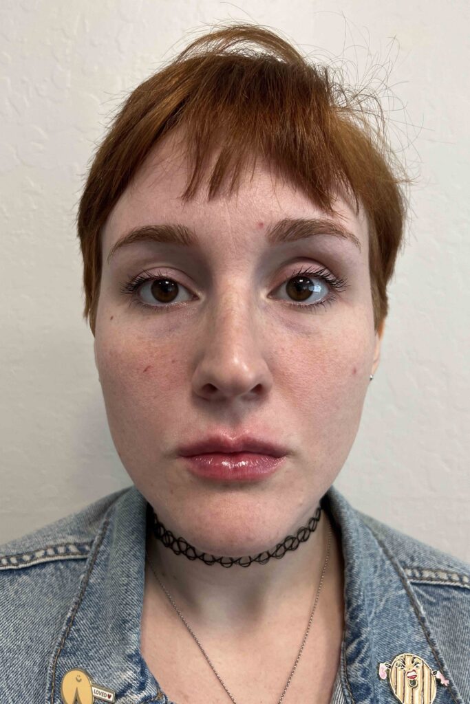 lip augmentation filler - after