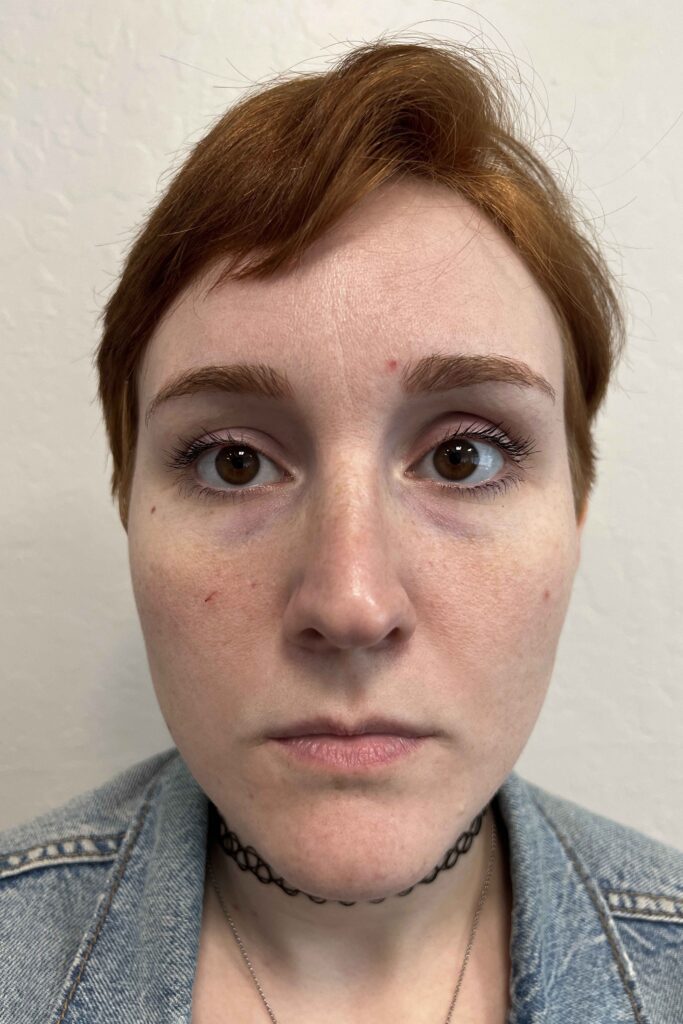 lip augmentation filler - before