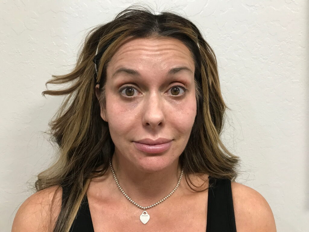 Botox Cosmetic After