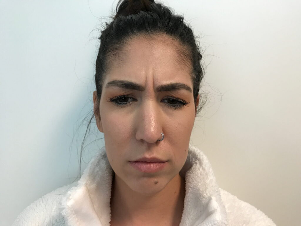 Botox Cosmetic Before