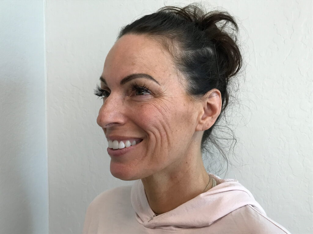 Botox Cosmetic After