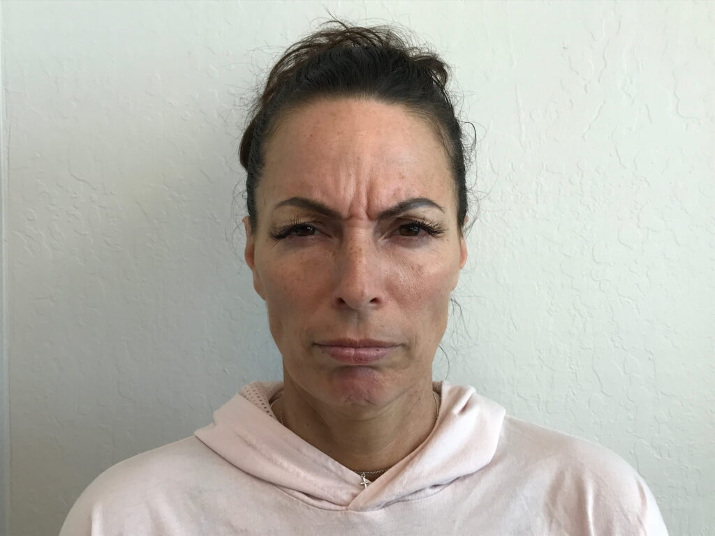 Botox Cosmetic Before
