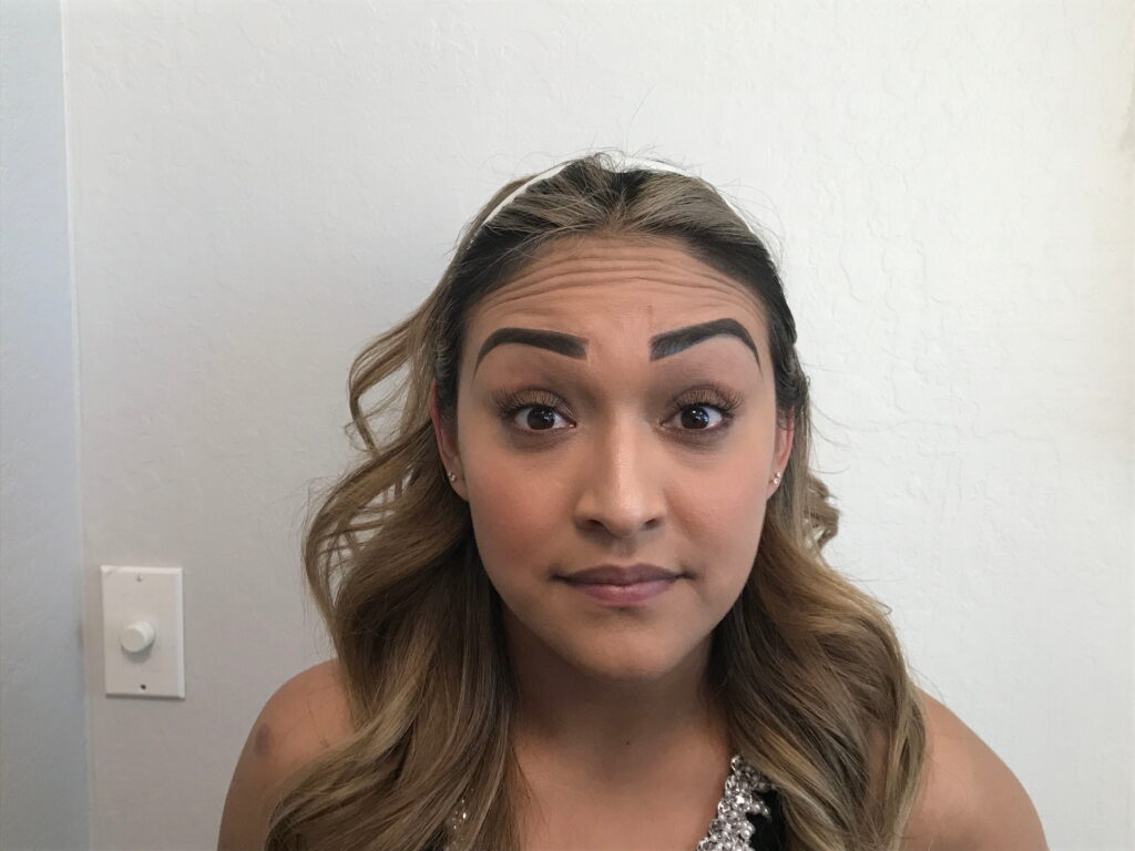 Botox Cosmetic After