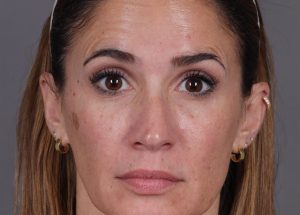 Botox Cosmetic After