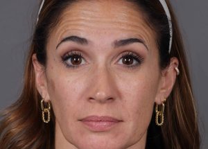 Botox Cosmetic Before