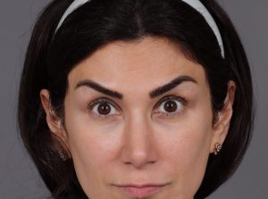 Botox Cosmetic Before