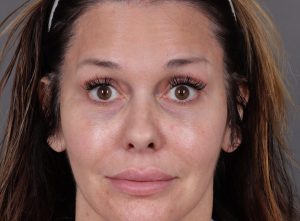 Botox Cosmetic Before