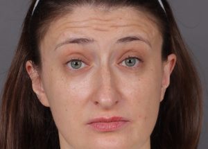 Botox Cosmetic Before
