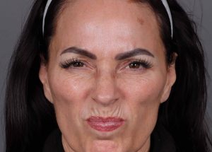 Botox Cosmetic Before