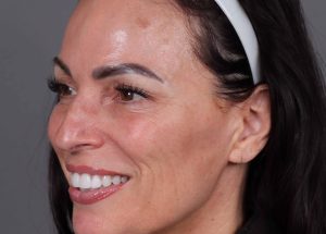 Botox Cosmetic After